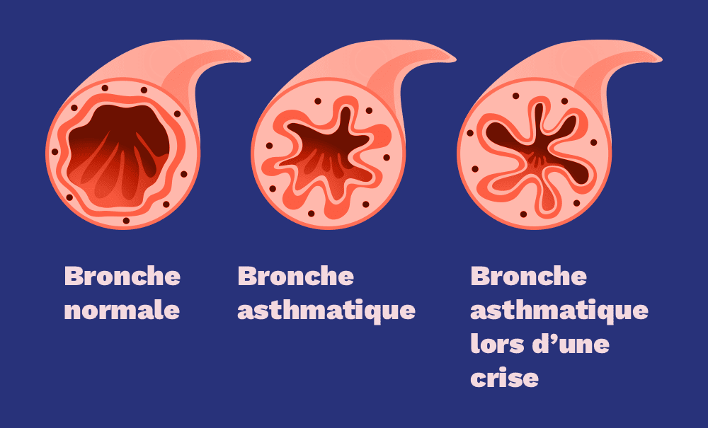 Bronche normale et Bronche pendant les crises d'asthme