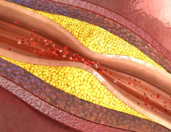 Plaque d'athérome dans un vaisseaux sanguin