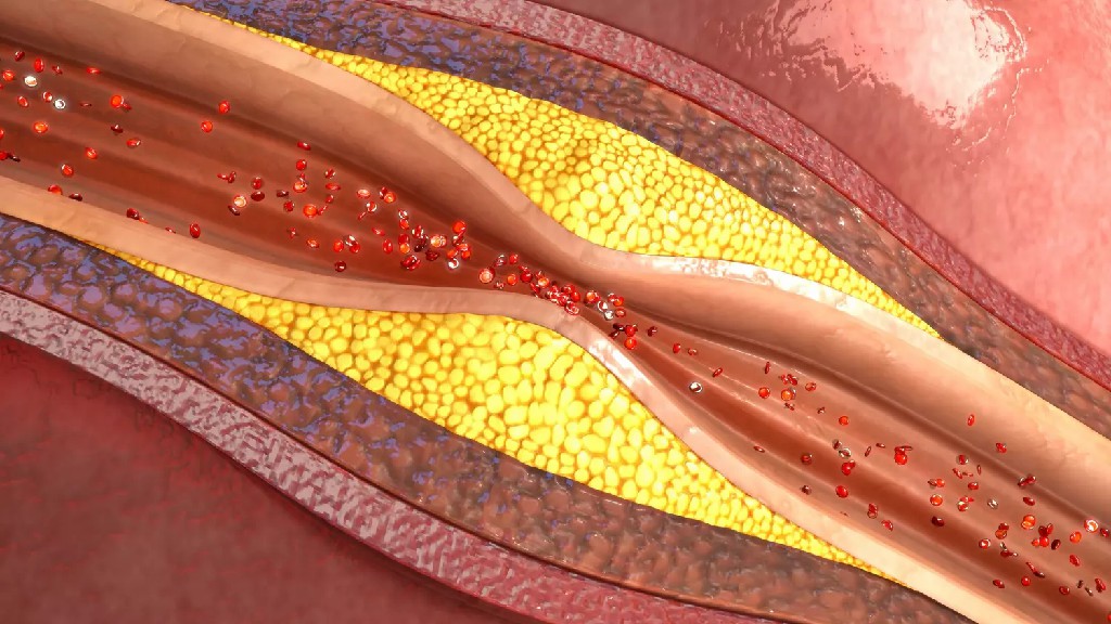 Plaque d'athérome dans un vaisseaux sanguin