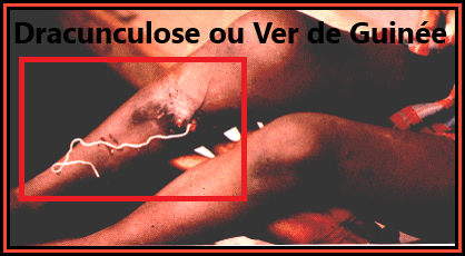 Image d'un long ver de guinée sortant d'une lésion de la jambe. Dracunculose (MTN)